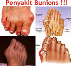 Wah, rasanya pasti sakit sekali dan seolah saat ujung ibu jari kaki kita terbentur, hal ini bisa terasa sangat sakit karena kekuatan benturan yang besar. Tulang Ibu Jari Kaki Sakit Nuring
