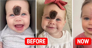 We Got Stares'', Parents Choose to Remove Baby Girl's Rare Birthmark to  Avoid Rude Reactions