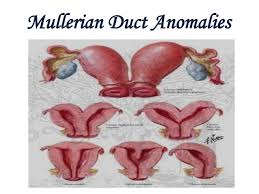 Müllerian agenesis is caused by embryologic underdevelopment of the müllerian duct, with resultant agenesis or atresia of the vagina, uterus, or both. Mullerian Anomalies