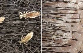 Image result for lice vs dandruff