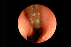 Cat de mult rau pot face polipii подробнее. Polipii Nazali Cum Polipii AfecteazÄƒ Alergiile Cum SÄƒ Le Trateze Alergii 2021
