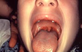In other words, strep throat can cause tonsillitis, but not all cases of tonsillitis are strep throat. Strep Throat Pictures What Does Strep Throat Look Like