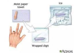 Dan waktu untuk membuktikan bahwa yang putus bisa disambung, yang rusak. Letak Ais Pada Anggota Badan Terputus Boleh Menyelamatkannya Ini Fakta Yang Perlu Anda Tahu