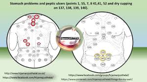 Peptik Ulkus Hijama Hijama Points Trigger Point Therapy