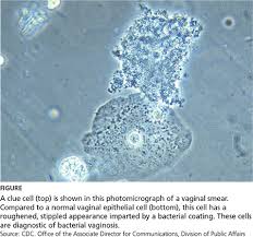You can also search for this author in pubmed google scholar. Acute And Recurrent Bacterial Vaginosis Clinician Reviews