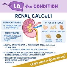 Image result for Calcium Nephrolithiasis