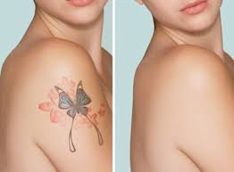 Doppelt at southeastern dermatology to schedule a consultation today. Rejuvi Non Laser Tattoo Removal Service Dubai Select Beauty Solutions