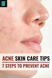 How To Treat Acne Prone Skin 7 Ways To Prevent Acne At Home Prevent Acne Acne Prone Skin Skin Care Acne