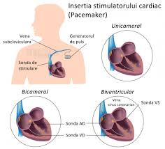 Strada gheorghe marinescu 4, târgu mureș 540080, romania vezi pe hartă localitate: Pacemakerele Stimulatoarele Cardiace Proceduri Medicale