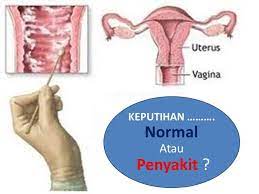 Bagaimanapun, darah haid bukan darah segar yang keluar dari tubuh. Bio Seleza Malaysia Singapore Indonesia Brunei Salam Sejahtera Pembaca Pembaca Yang Manis Jenis Keputihan 1 Bila Cecair Yang Keluar Berwarna Jernih Berlendir Banyak Tetapi Tidak Berbau Maka Hal Ini