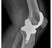 Vista de Fractura del poste tibial en la artroplastia total ...