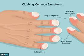 Image result for Clubbing nails feet