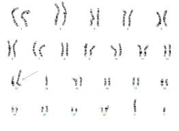 Die robertson'sche translokation 15;21 sowie das ringchromosom 21 sind sehr seltene chromosomale aberrationen, die zu einem deutlich erhöhten risiko für die entwicklung einer all. Chromosomenanalysen Allgemeine Informationen Dna Diagnostik Hamburg Gemeinschaftspraxis Fur Humangenetik Und Genetische Labore