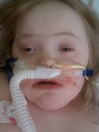 Pray for 18-month-old's recovery after popcorn kernel inhalation