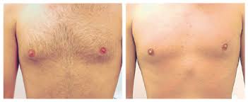 It is a bit more painful. Best Laser Hair Removal In Melbourne Dermacare Dermacare Cosmetic Laser And Skin Clinic Melbourne