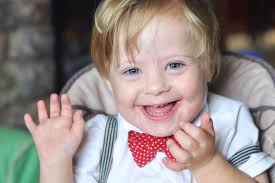 How And Why Down Syndrome Can Go Undetected In Pregnancy