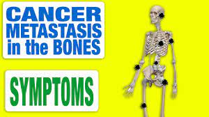 Cancer that has spread to your bones can also be painful. Cancer Metastasis In The Bones All Symptoms Youtube