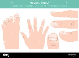 Image result for Clubbing nails feet