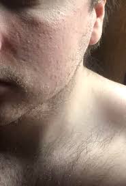 Maybe you would like to learn more about one of these? Skin Concerns How To Get Rid Of This Rough Uneven Texture On Skin Around My Jaw It Is Very Smooth In The Mid Face It Is Rough And Uneven From Contact Dermatitis