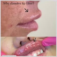 The Lip Filler Has Migrated To The Edge Of Her Top Lip. Just Dissolve It  Sis! There'S Nothing Wrong With Natural Lips 🙄 : R/Aspynovardsnark