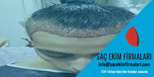 Sac Ekimi 90 Gun Sac Ekimi Mart 2021
