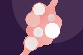 Treatment of polycystic ovary syndrome is individualized to treat prevailing signs/symptoms and generally focused on correcting irregular bleeding from the uterus, restoring fertility, improving the skin manifestations of androgen excess (hirsutism, acne, hair loss), and preventing diabetes and cardiovascular disease.more recently, attention has also focused on improving. What Is Pcos Polycystic Ovary Syndrome Natural Cycles