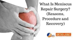 What Is Meniscus Repair Surgery Reasons Procedure And Recovery Meniscus Tear Knee Meniscus Repair