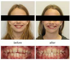 Check spelling or type a new query. Orthodontic Habits And Problems In Kids Hometown Orthodontics