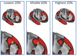 Check spelling or type a new query. Individual Variation In Brain Network Topography Is Linked To Schizophrenia Symptomatology Biorxiv