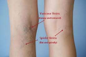 Best Compression Stockings For Varicose Veins In Malaysia Mommy Lynn