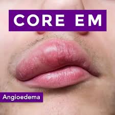 Image result for Angioedema