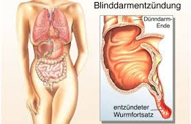Nur bauchweh oder ein kranker blinddarm? Blinddarmentzundung Appendizitis Ksw Kantonsspital Winterthur