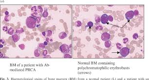 Symptoms of pure rbc aplasia are generally mild and relate to the degree of the anemia or to the underlying disorder. Pdf What Is Antibody Mediated Pure Red Cell Aplasia Prca Semantic Scholar