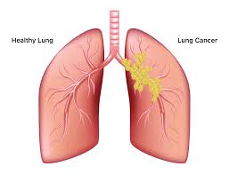 If a biopsy proves that cancer is present, your doctor can determine how far it has spread. Lung Cancer Symptoms Causes Treatment And Survival Rates