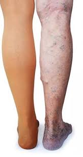 Even when a blood vessel is not injured, blood clots may form in the b. Behandeling Van Trombose Bij Kanker Pfizer