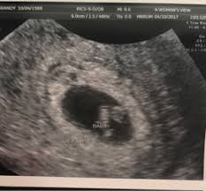 3) how early pregnancy scan help for dating ? Dating Scan 6 Weeks 4 Days Too Early December 2017 Babies Forums What To Expect Page 2