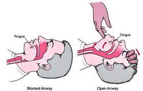 A manoeuvre for opening the airway of an unconscious patient. Head Tilt Chin Lift Maneuver Jaw Thrust Maneuver