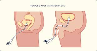 Image result for Urethral Catheterization