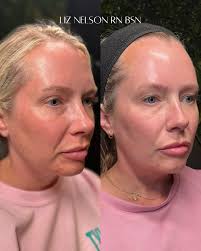 Revitalizing Your Skin: The Power of Microneedling