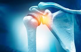 Image result for Rotator Cuff Rupture