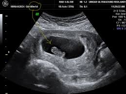 Image result for First Trimester Ultrasound