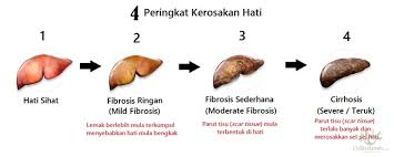 Rawatan Atasi Masalah Hati Berlemak Fatty Liver Vitamin Semulajadi