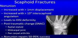 Image result for Fracture Complication