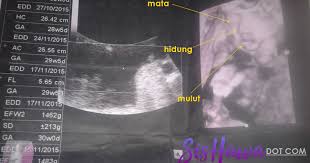 Scan jantina bayi perlu dilakukan bagi mendapatkan pengesahan namun sejauh mana ketepatannya? Cara Membaca Result Ultrasound Kehamilan