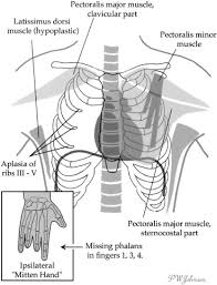 Poland syndrome is noted for the underdevelopment or absence of the chest (pectoralis) muscles on one side of the body as well as webbing of the fingers (cutaneous syndactyly) on the hand of the. Poland S Syndrome Revisited Sciencedirect