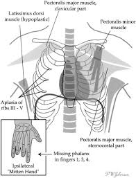 Reconstructive surgery is the main treatment. Poland S Syndrome Revisited The Annals Of Thoracic Surgery