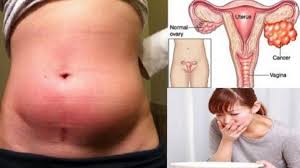 Beberapa ciri lain yang juga biasa ditemukan antara lain adanya masalah frekuensi buang air kecil dan sakit saat buang air kecil. Dua Gejala Dini Kanker Rahim Yang Paling Sering Diabaikan