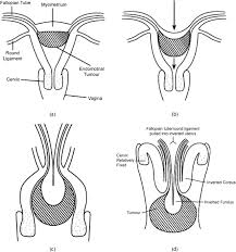 Image result for Uterine Inversion