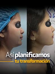 Muchos piensan que la armonización facial es solo para rellenar, pero  también puede ayudarte a definir el rostro y afinar los rasgos 😉💉 En este  caso, trabajamos en reducir la papada, marcar el borde ...