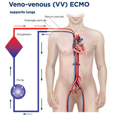 Extracorporeal membrane oxygenation (ecmo), also known as extracorporeal life support (ecls), is an extracorporeal technique of providing prolonged cardiac and respiratory support to persons whose. Vv Ecmo Learnecmo